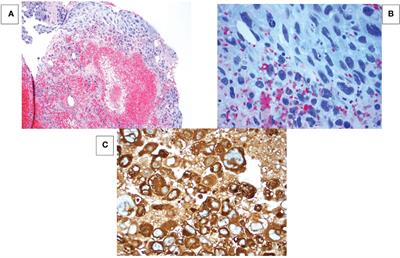 Case report: Metastatic metaplastic breast cancer with choriocarinomatous features: Targeting the choriocarcinoma component for cure